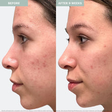 Load image into Gallery viewer, Recovery Spot Cream (Acne Line)