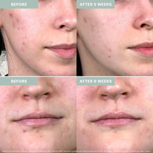 Load image into Gallery viewer, Acne Spot Treatment (Acne Line)